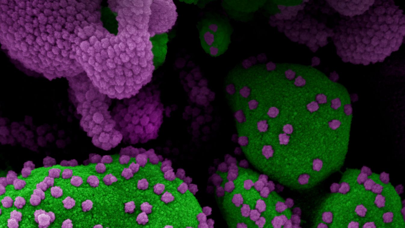 SARS-CoV-2 vírusrészecskékkel (lila) fertőzött sejtek (zöld) elektronmikroszkópos felvételen 
