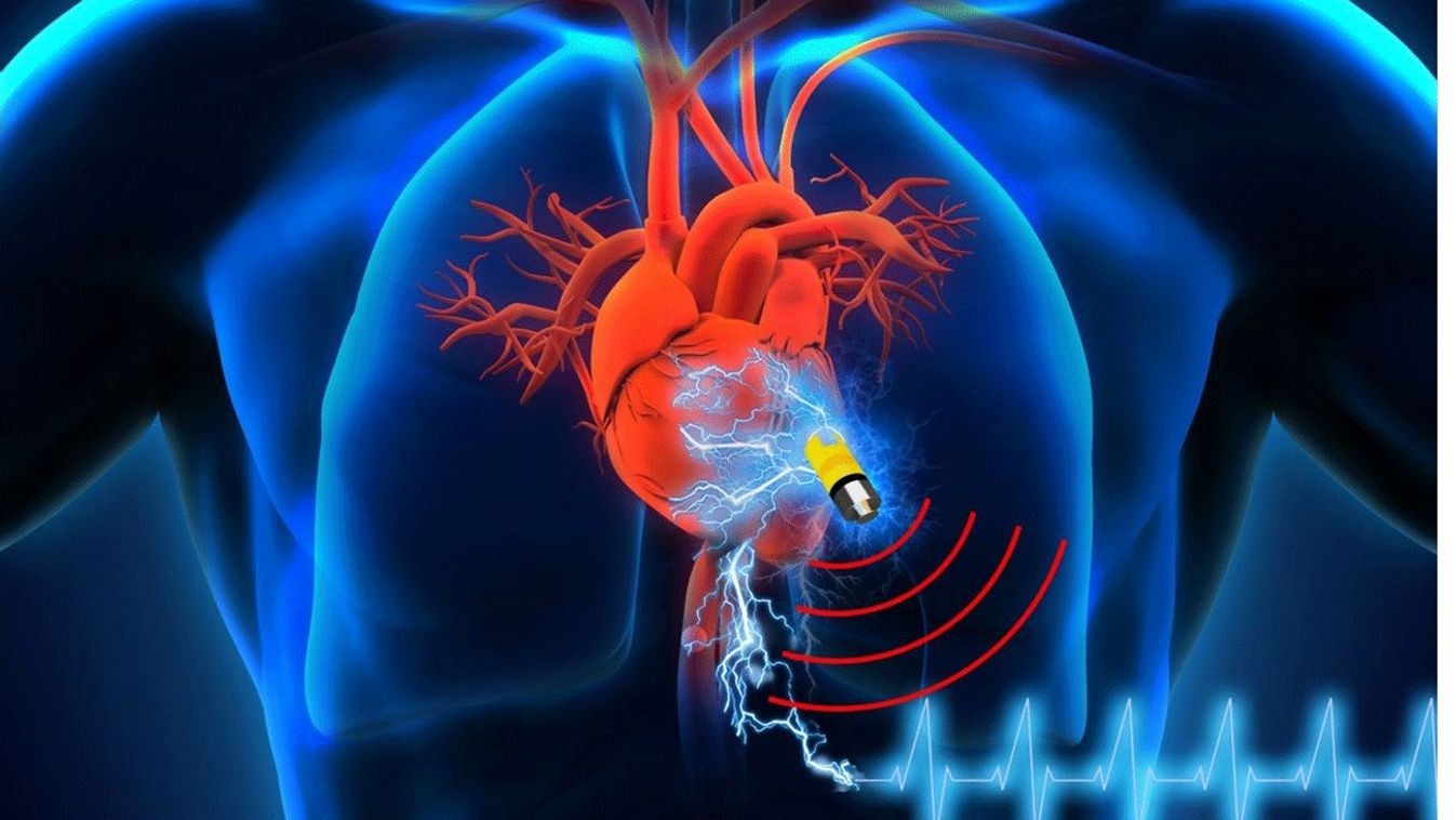 pacemaker, szívritmus-szabályozó 