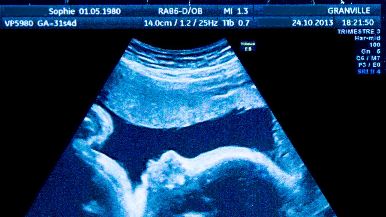 Fetus sonography EXAMINATION MEDICAL EXAMINATION result developing PROFILE human scientific imagery medical imagery ULTRASOUND SCAN fetal ultrasound scan MEDICINE obstetric fetus third trimester Investigate Inspection Inspect Examining magzat 
