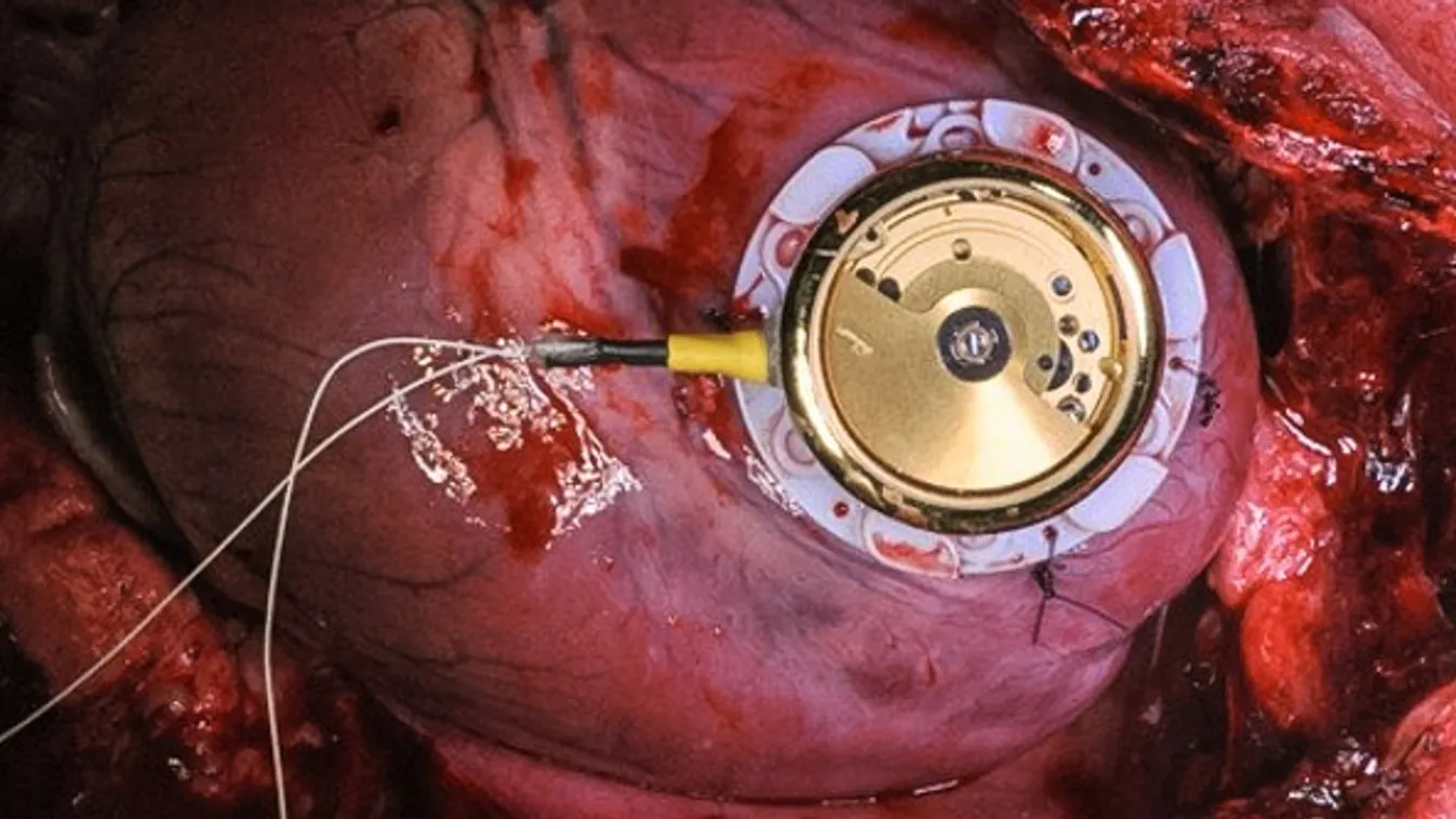 szívritmus-szabályozó pacemaker óramű 