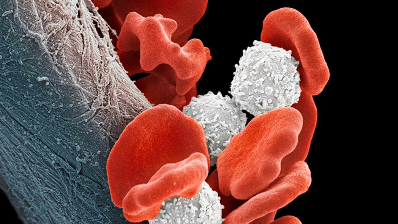 gyermekkori leukémia, vörösvérsejtek és rákos fehérvérsejtek, illusztráció