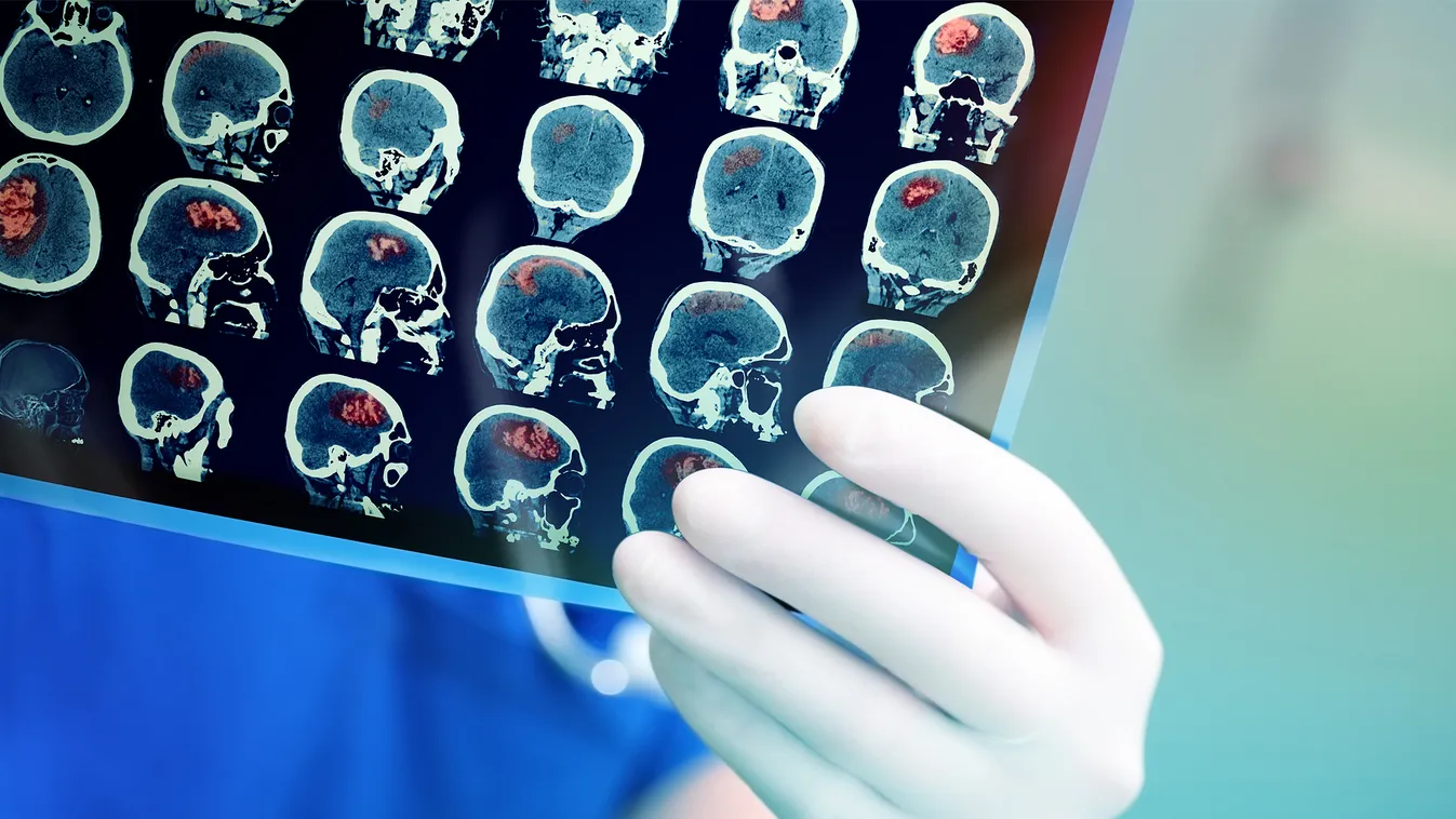 Dr. Life, Kivédhető lenne szinte minden stroke? agyvérzés agy MRI vizsgálat kórház 