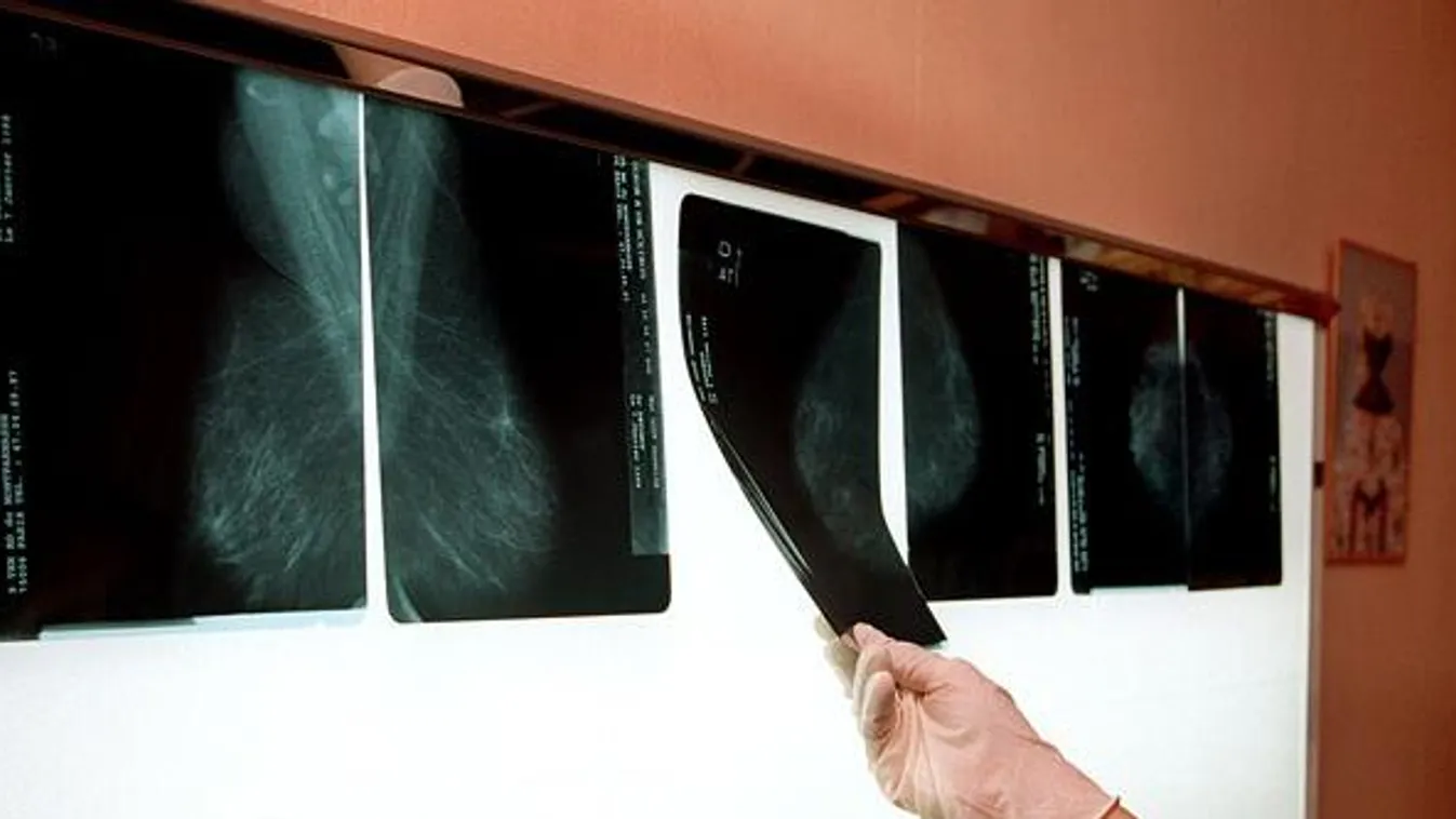 Mammográfiai szűrőviszgálat, rákszűrés, emlő viszgálat, röntgen felvételek 