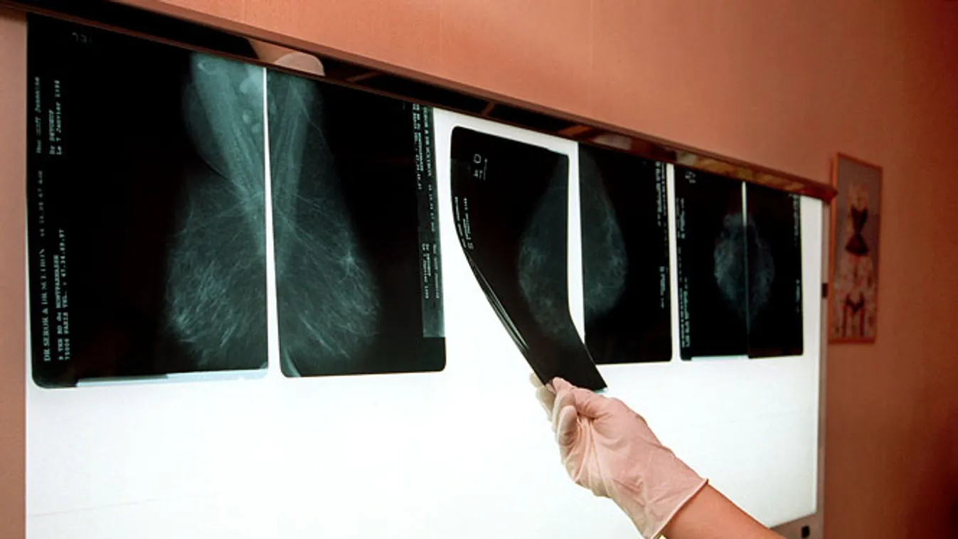 Mammográfiai szűrőviszgálat, rákszűrés, emlő viszgálat, röntgen felvételek 