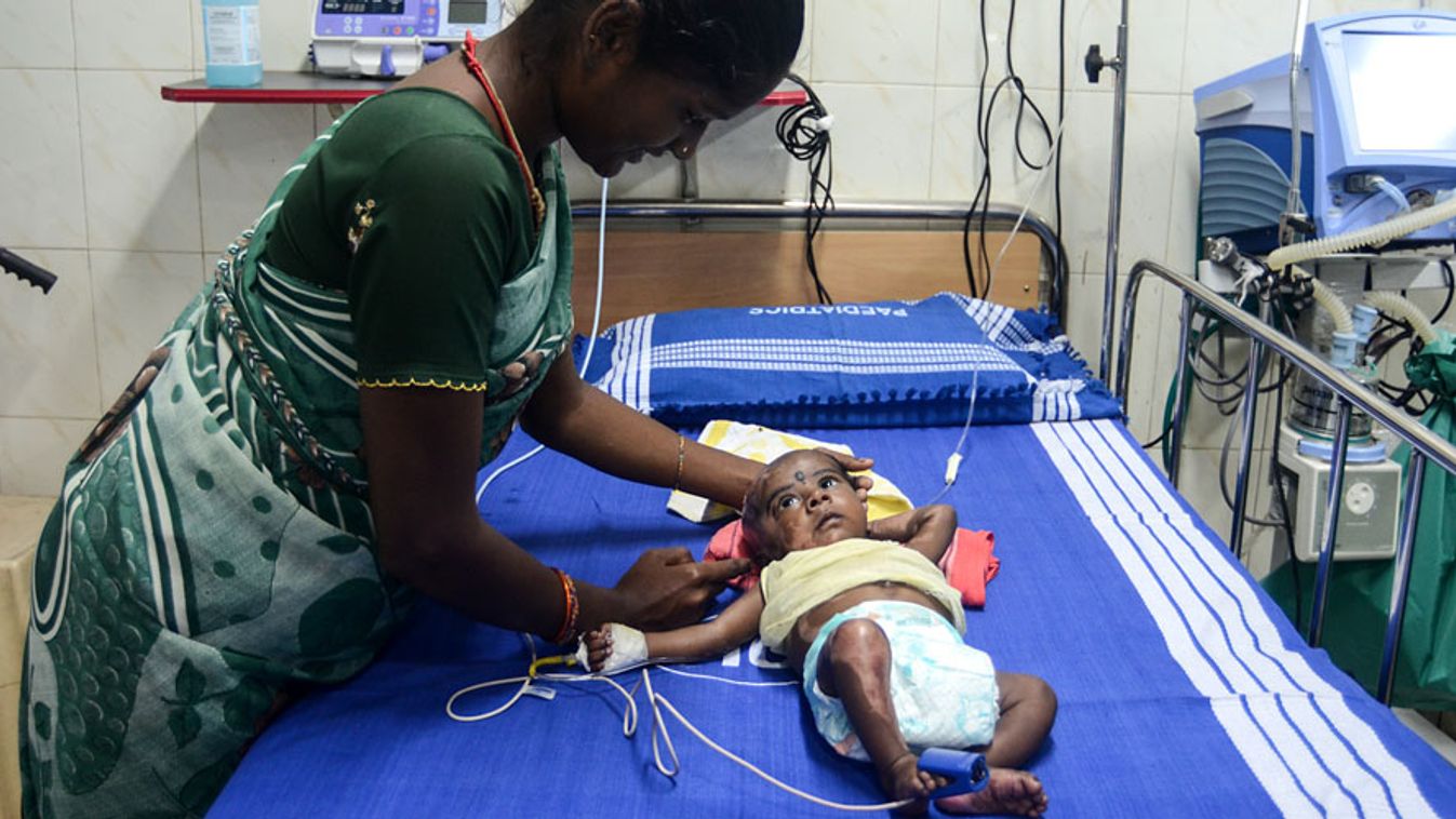 Rahul a 3 hónapos indiai csecsemő aki spontán lángra kapott, Chennai