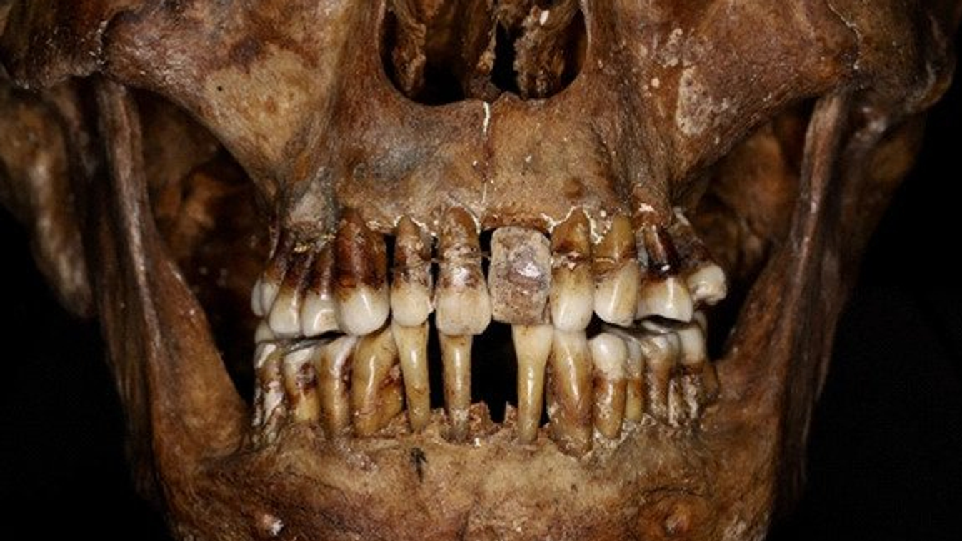 koponya, fogak, fogpótlás 