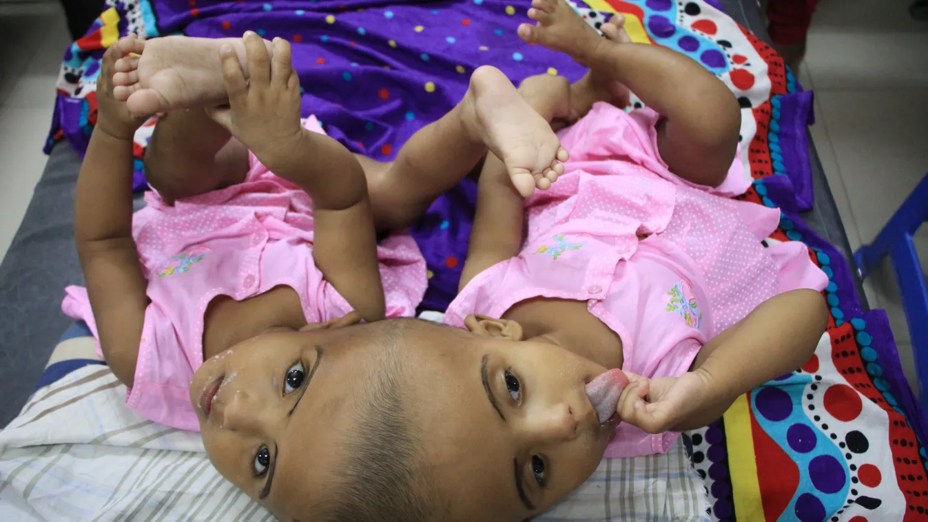Magyar orvoscsapat választja szét a fejüknél összenőtt bangladesi sziámi ikreket, Rabiát és Rukiyát 