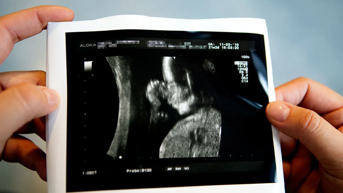 ultrahang-felvételét nézi egy terhes kismama, születési rendellenesség