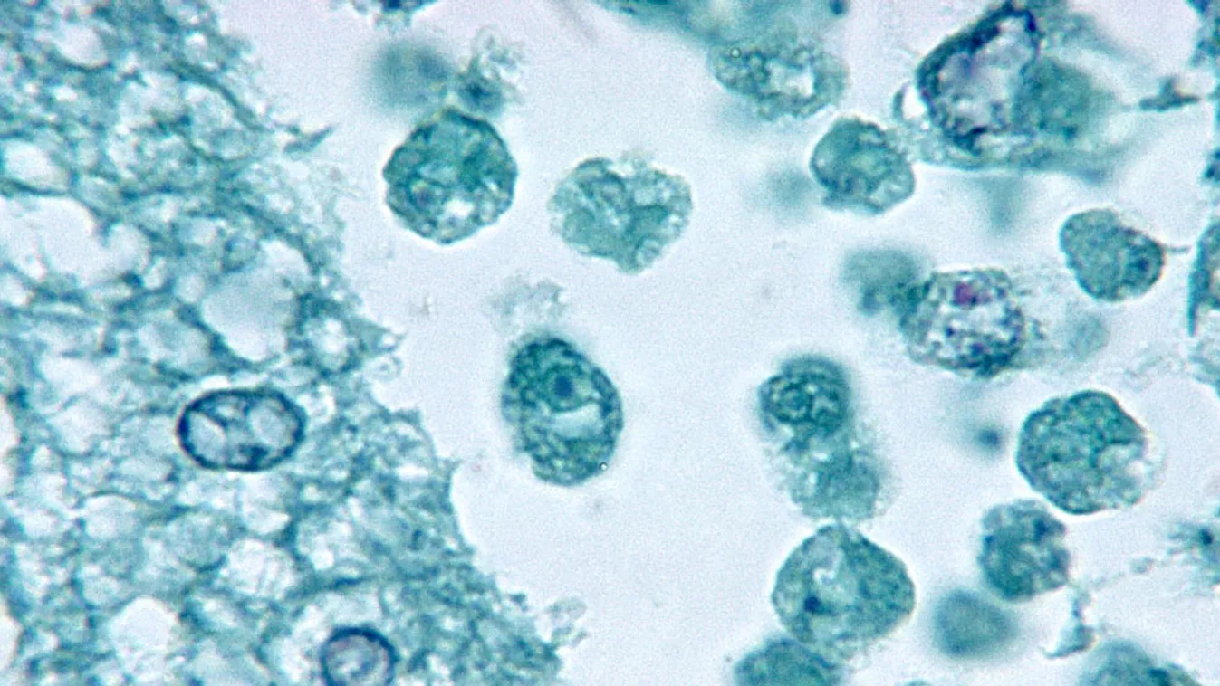 Mikroszkópkép a Naegleria fowleri fertőzés által megtámadott agyszövetről (az eredeti képnél kontrasztosabbra állított felvétel)