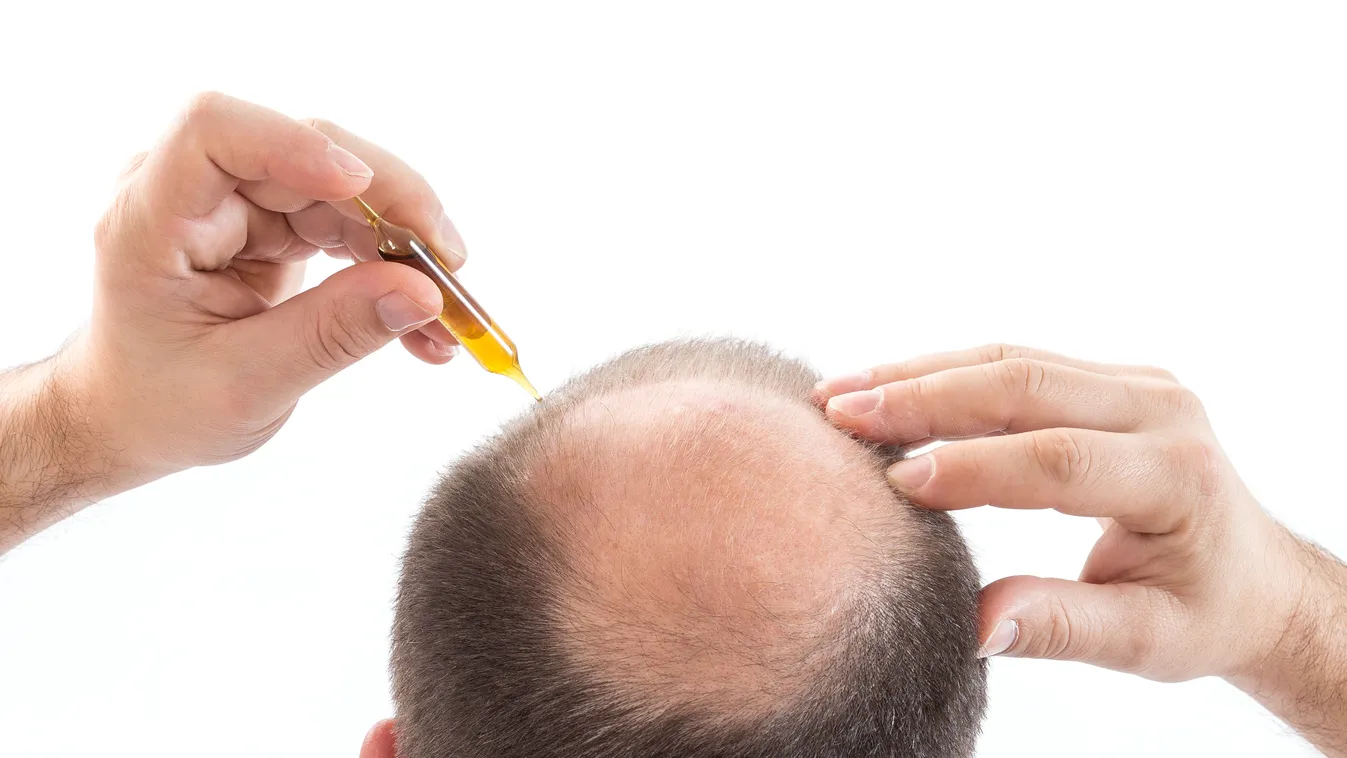 kopaszság Alopecia CARE head plain background CLOSE-UP ALONE BACK VIEW 40-50 years human person ADULT EUROPEAN male MAN MEDICINE DERMATOLOGY hair hair loss baldness 