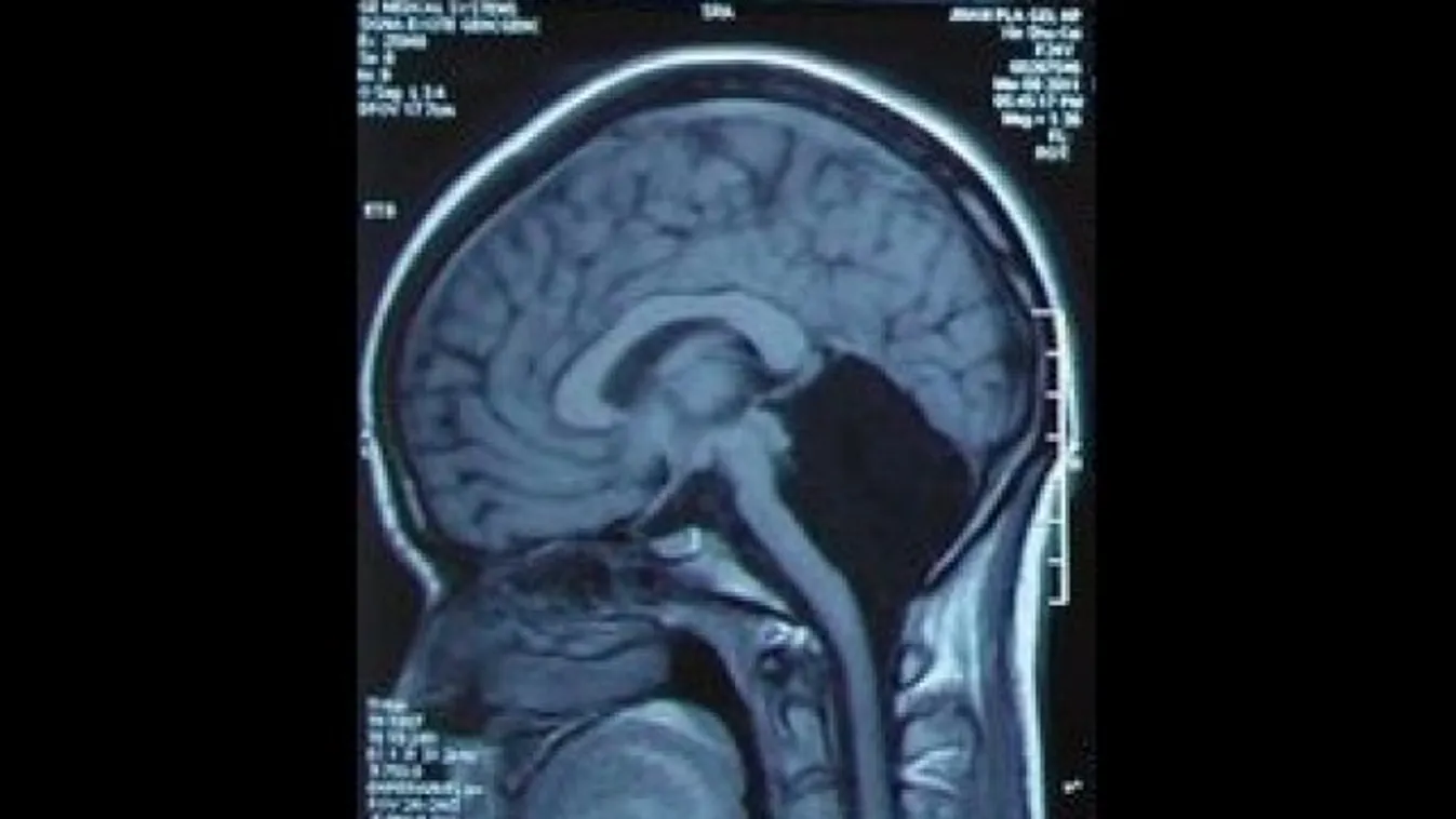 MRI felvétel, kisagy, CT, hiányzó kisagy 