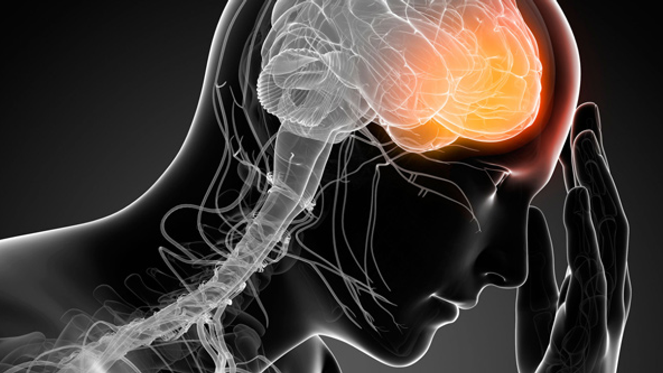 botox-kezeléssel részben megelőzhető a migrénes fejfájás