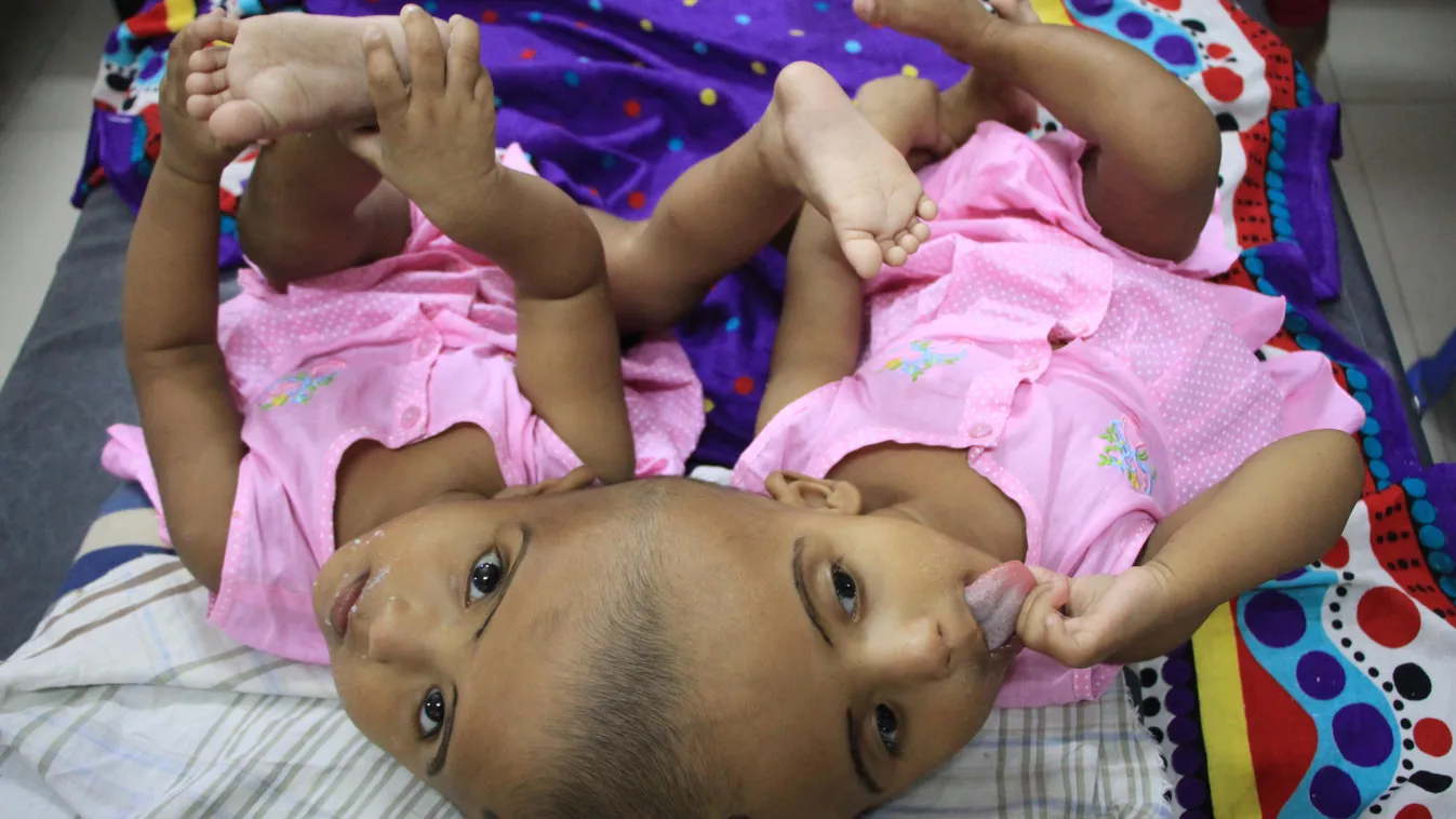 Magyar orvoscsapat választja szét a fejüknél összenőtt bangladesi sziámi ikreket, Rabiát és Rukiyát 