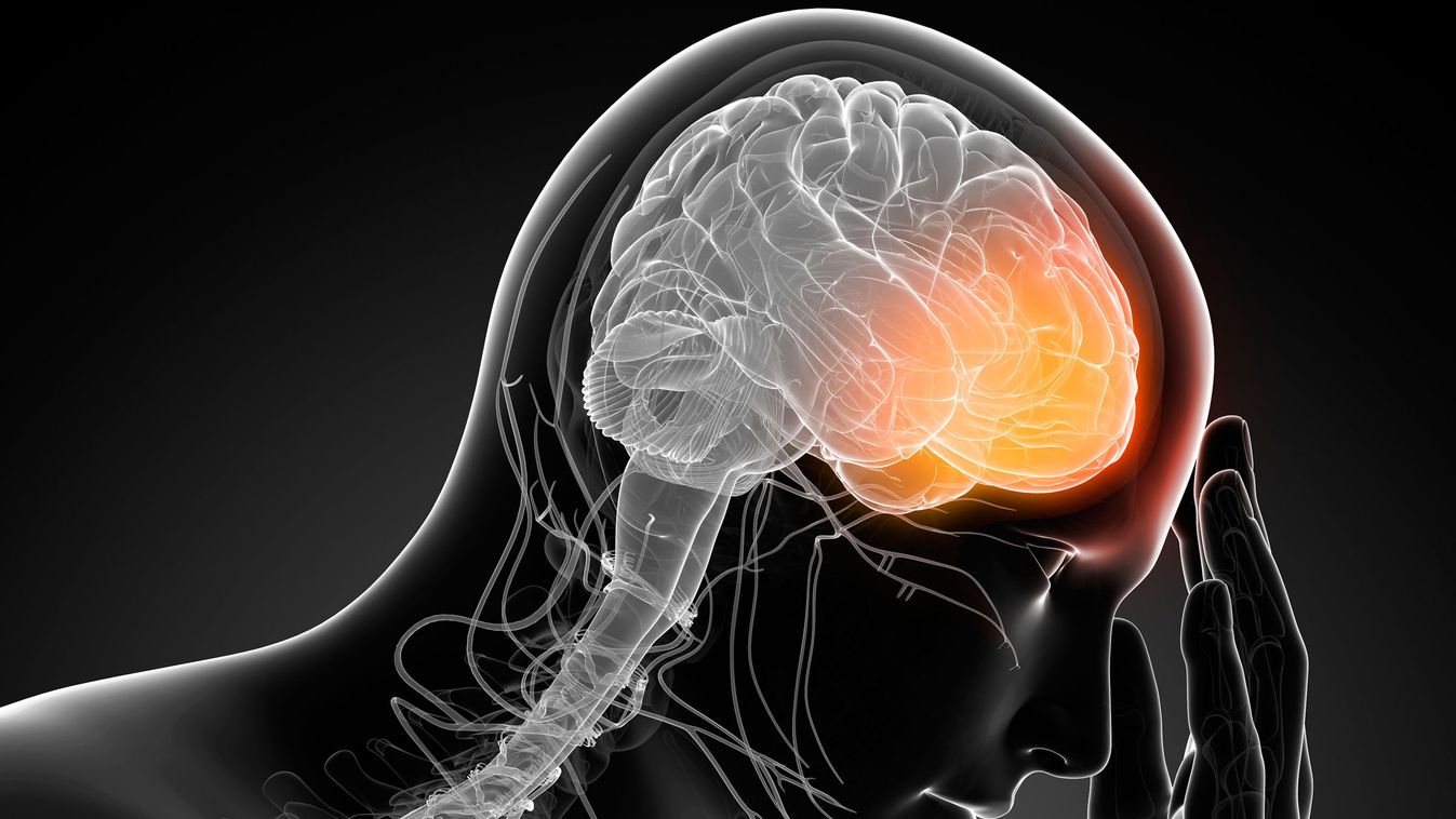 botox-kezeléssel részben megelőzhető a migrénes fejfájás 