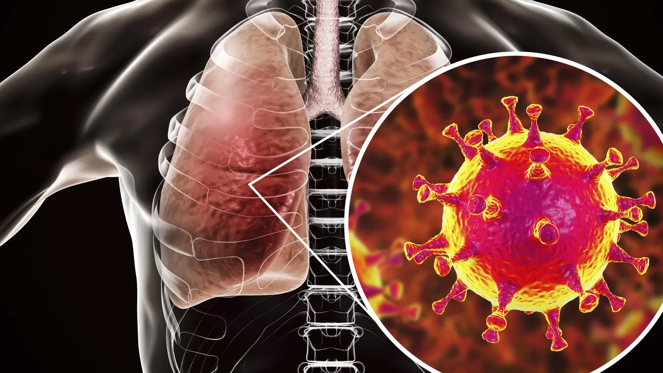koronavírus MERS virus infection of lungs, conceptual illustration artwork ATTACK BIOLOGY capsid close up common COLD condition corona VIRUS corona-virus coronavirus DISEASE disorder healthcare human infection medical 