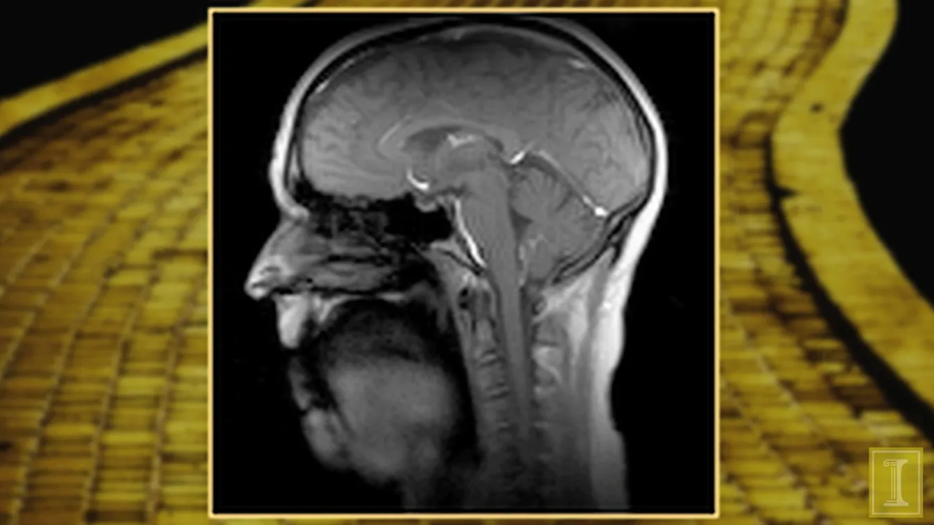 MRI felvétel 