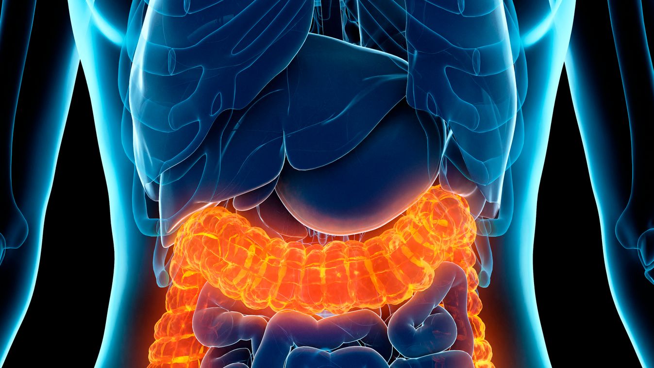 Diseased colon, illustration 3d rendering graphic artwork medical human anatomical unhealthy abnormal organs inside internal transparent inflamed pain painful inflammation injury infection female irritable bowel syndrome disorder rectal colitis crohn inte