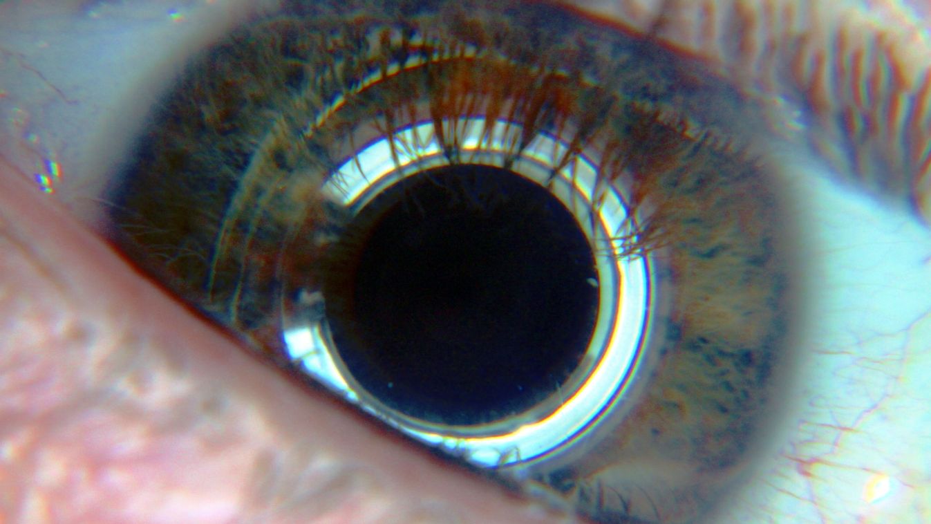 szem implant biohack 
