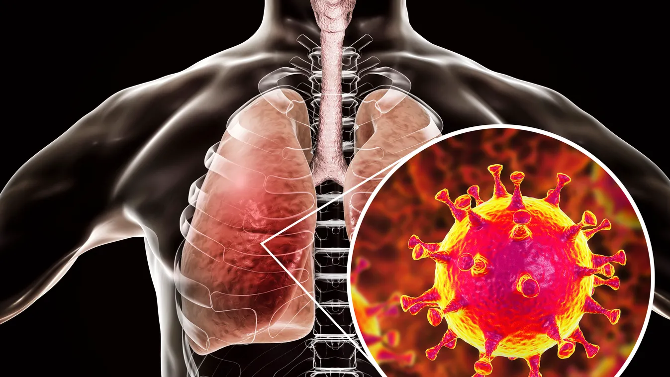 koronavírus MERS virus infection of lungs, conceptual illustration artwork ATTACK BIOLOGY capsid close up common COLD condition corona VIRUS corona-virus coronavirus DISEASE disorder healthcare human infection medical 