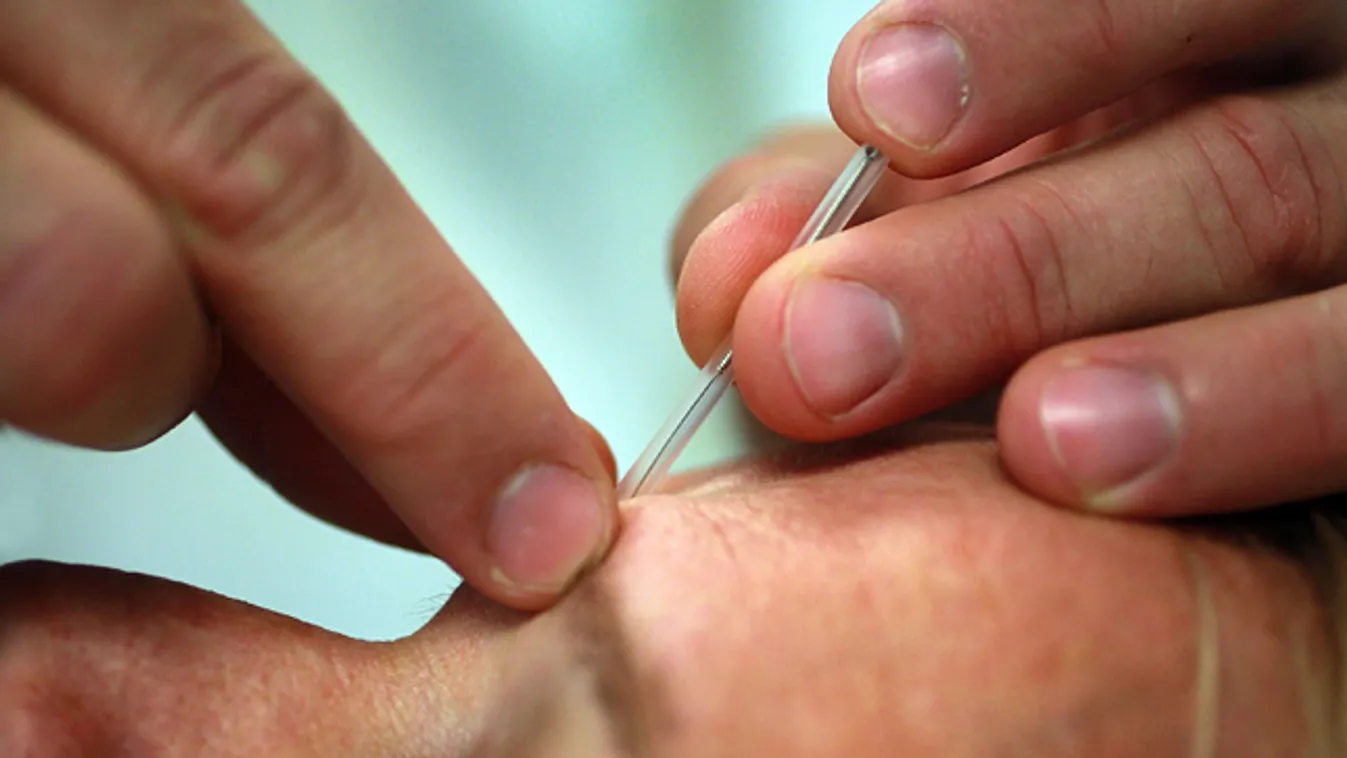 akupunktúra, akupunktúrás kezelés egy miami klinikán 