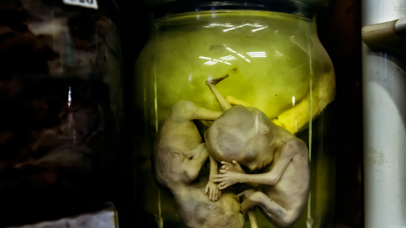 Fetus of human twins with pathology subcutaneous hemorrhage in jar with formalin. embrió 