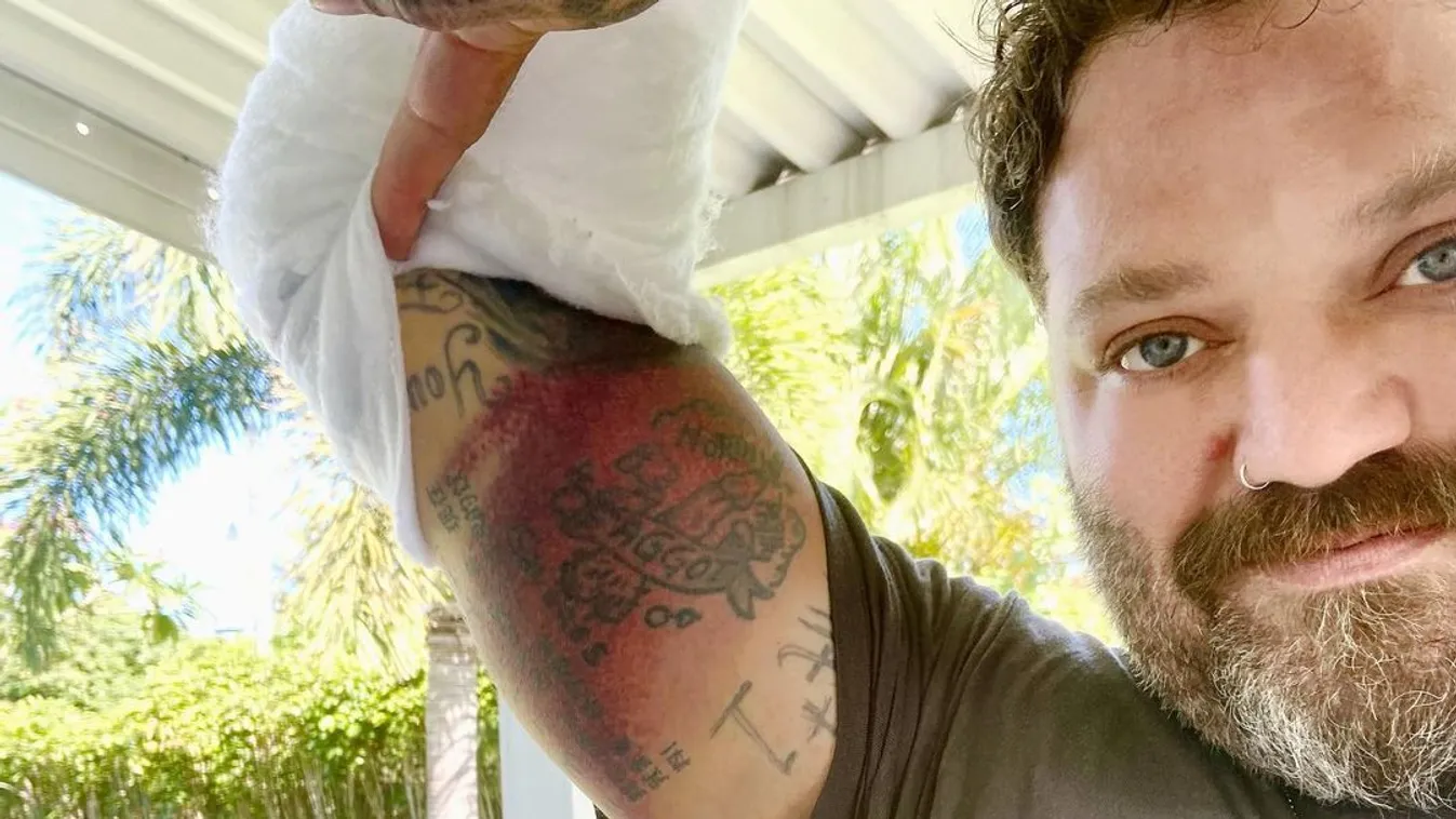 Bam Margera baleset után 