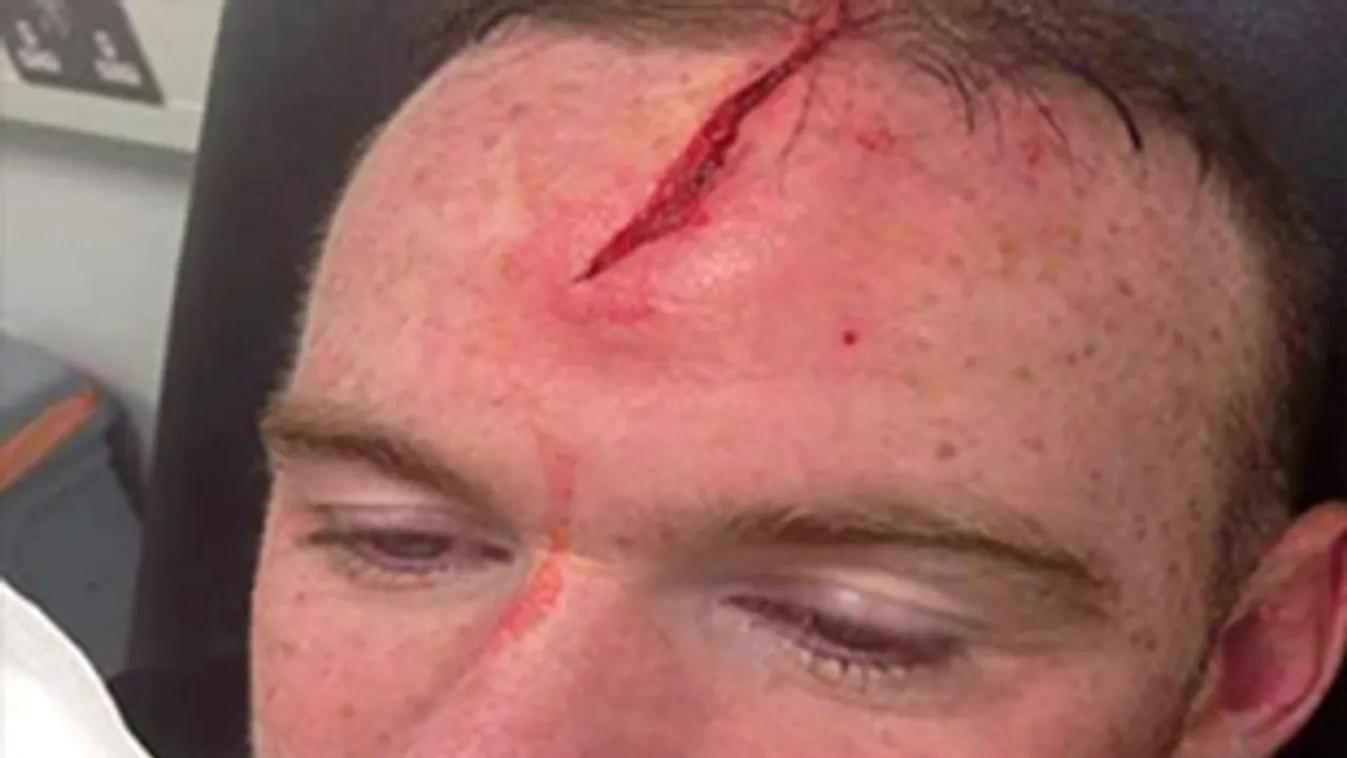Wayne Rooney angol labdarúgó fejsérülést szenvedett nyaralás közben