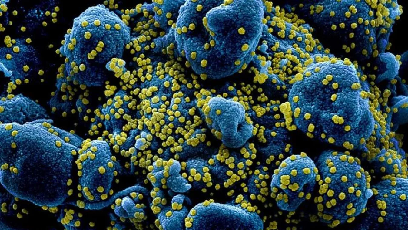 A koronavírus (sárgával) egy sejtet (kék) támad az elektronmikroszkópos felvételen 