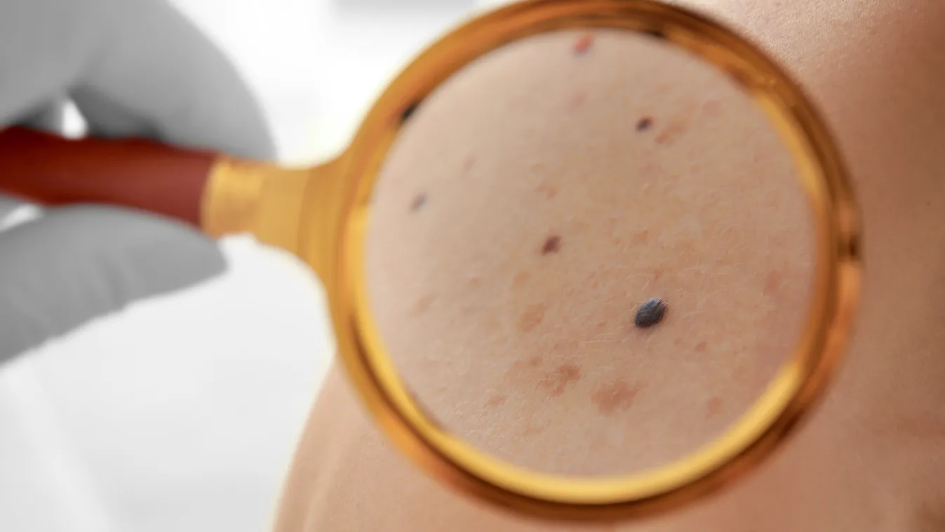 melanoma bőrrák bőrgyógyászati vizsgálat nagyító 