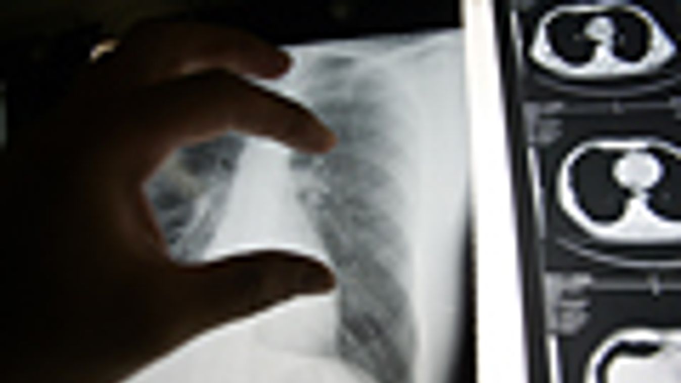 orvosi tű a beteg mellkasában, röntgen felvétel