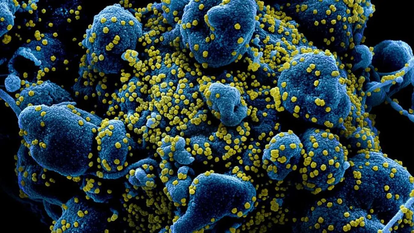 A koronavírus (sárgával) egy sejtet (kék) támad az elektronmikroszkópos felvételen 
