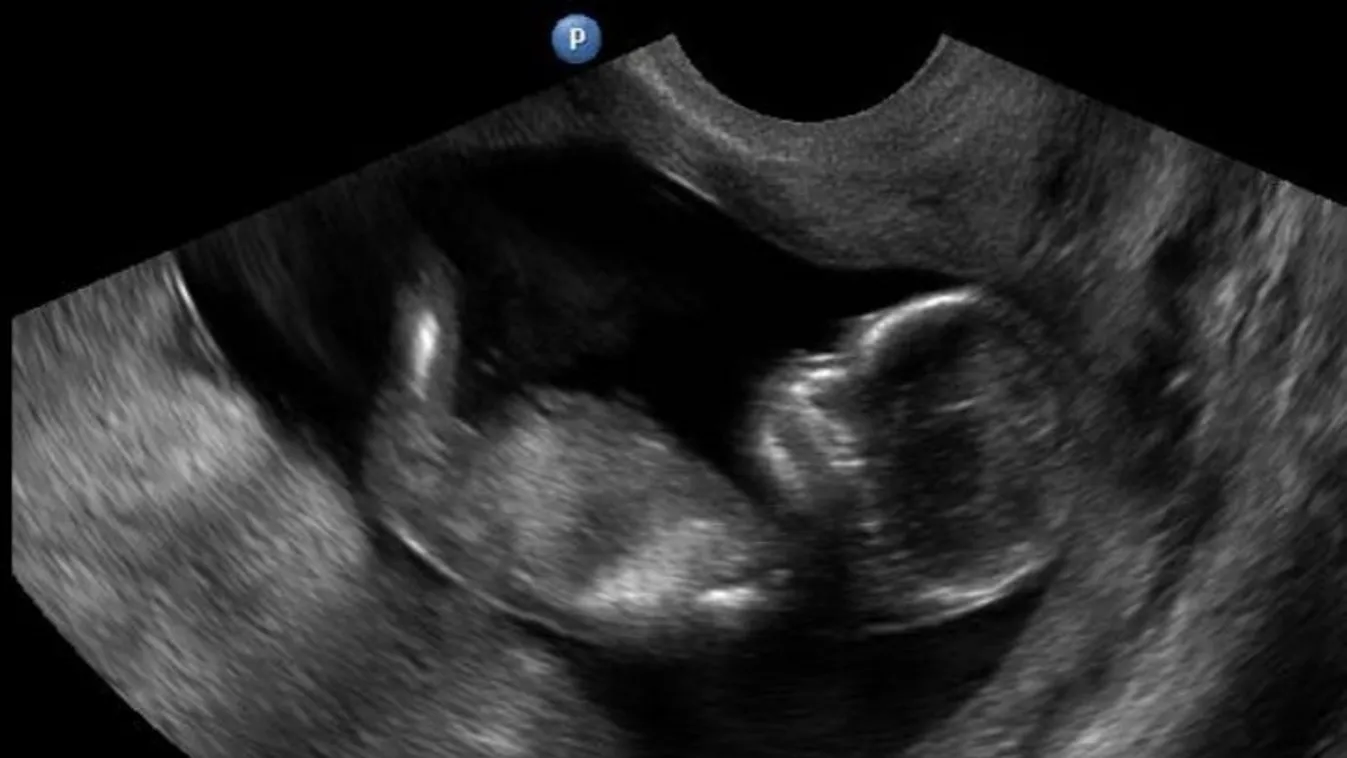 ultrahang, UH, magzat, baba, szívhang 