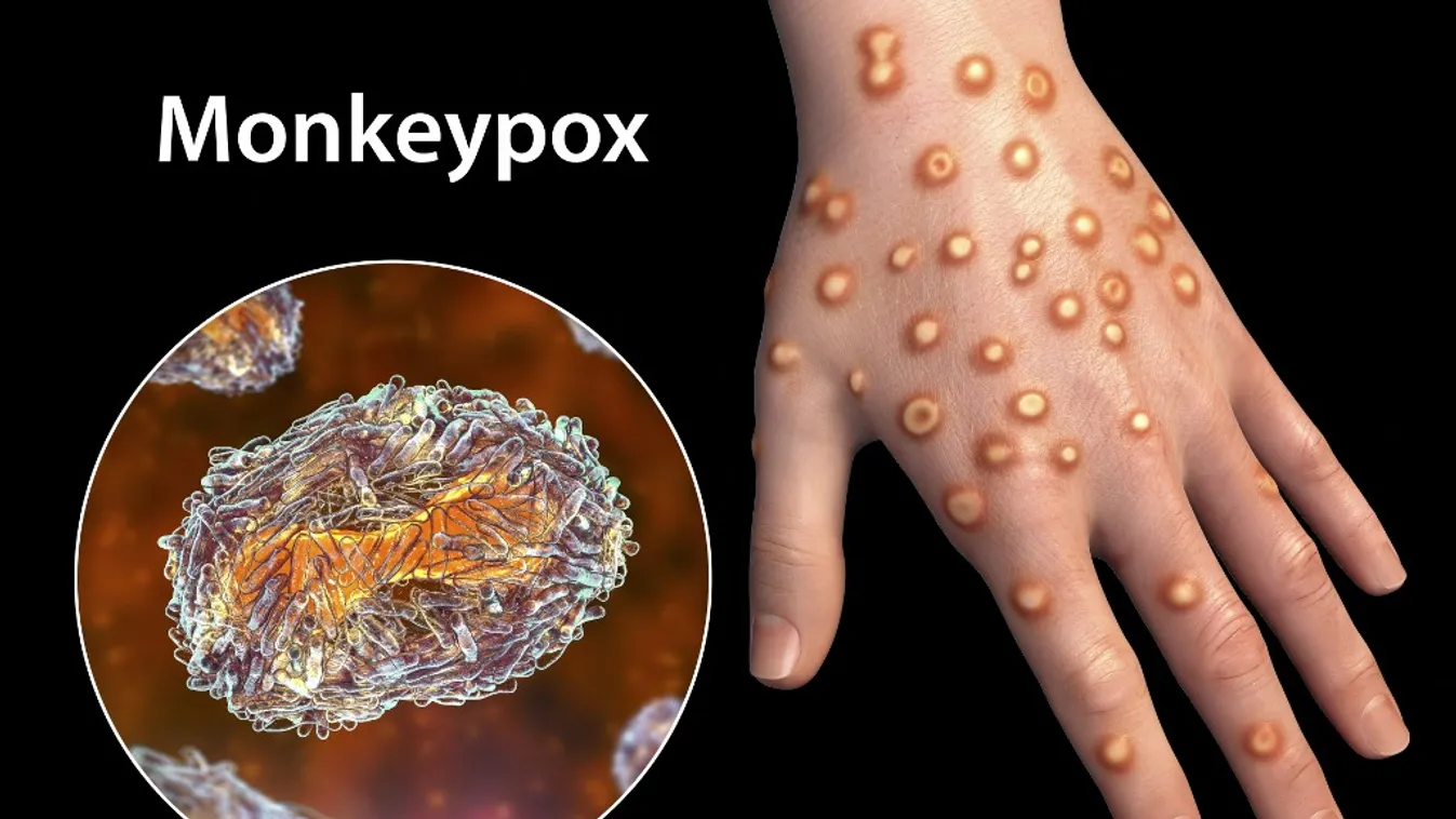 Így fest egy majomhimlő fertőzésben szenvedő beteg keze, és egy közeli nézet a majomhimlő vírus részecskéiről - számítógépes illusztráci 