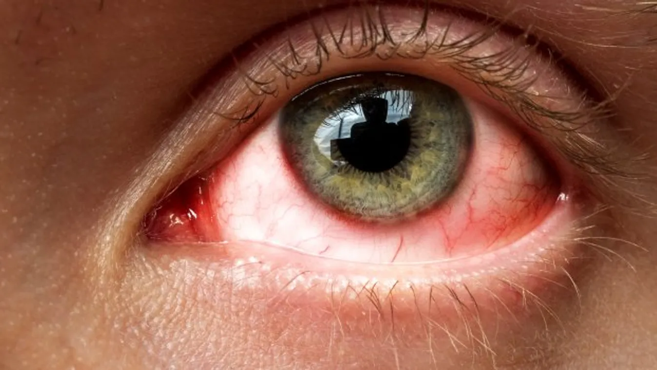 szem, szemggyulladás, allergia 