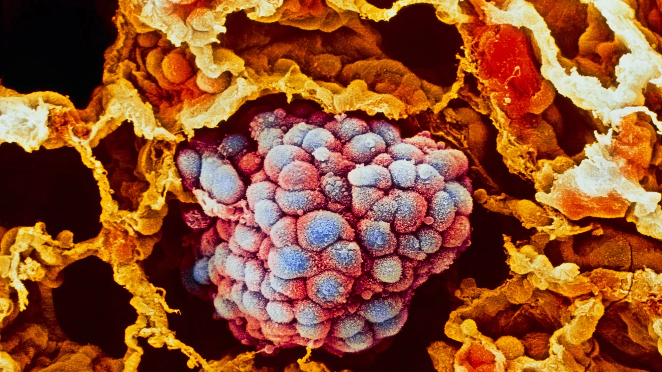 A daganatok fizikája, rákos sejt a tüdőben