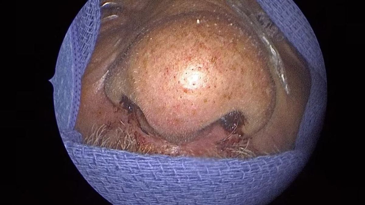 Horror a klinikán, 150 élő bogarat távolítottak el egy floridai férfi orrából - videó