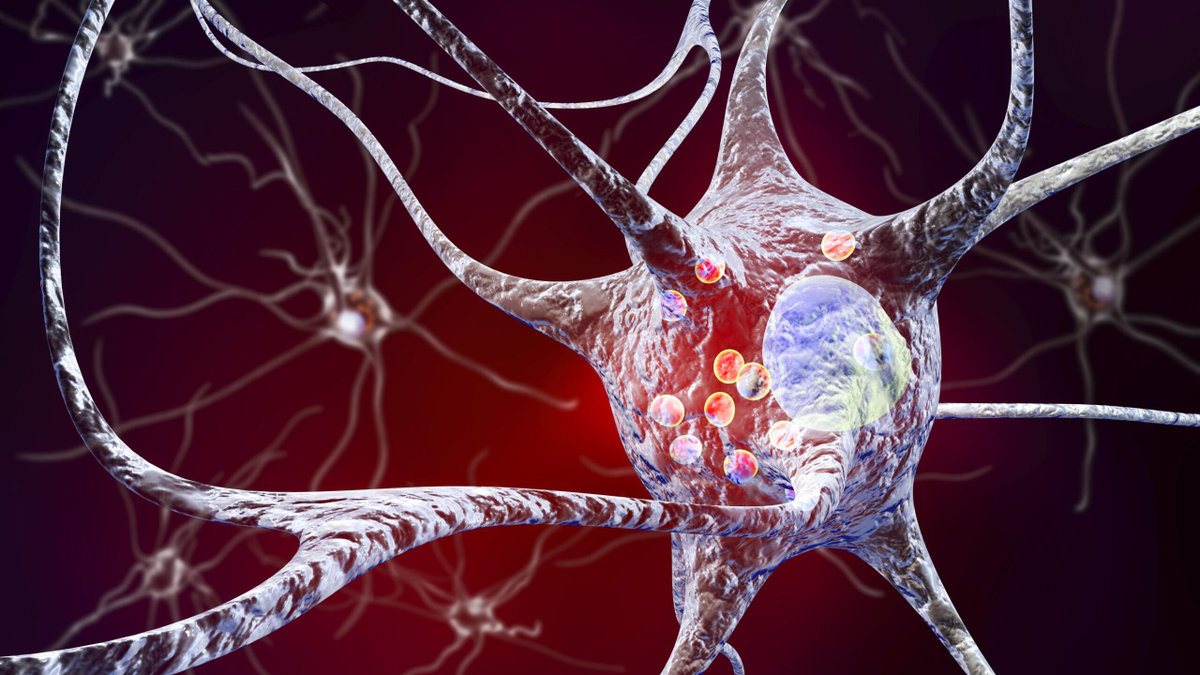 Áttörés a Parkinson-kór gyógyításában
