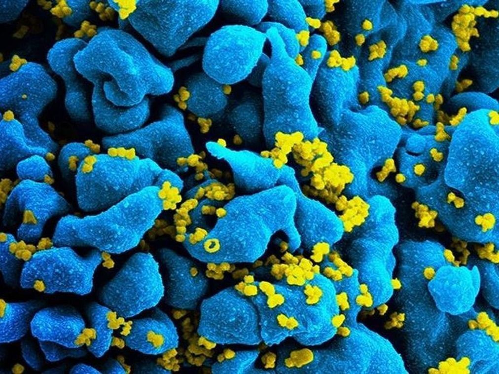 HIV-vírusok elektronmikroszkópos felvételen.