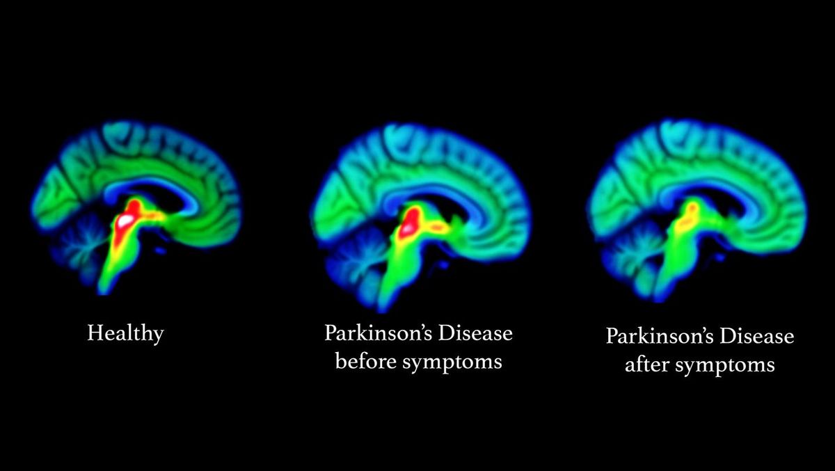 Parkinson-kór állapotai