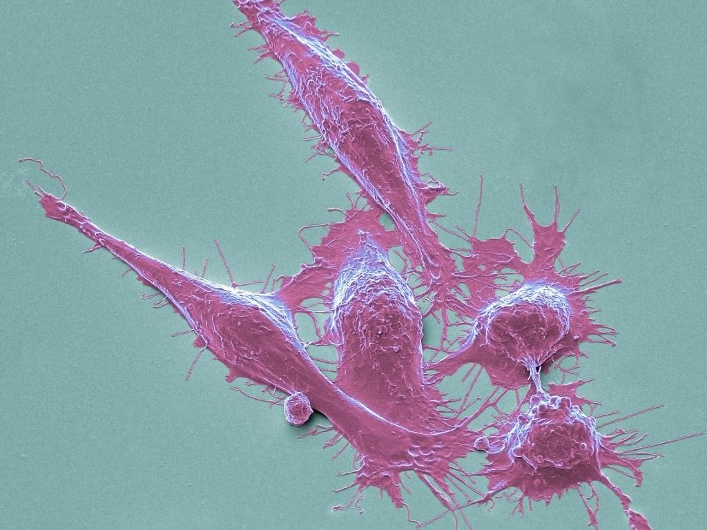 ráksejtek Colorectal cancer cells, SEM