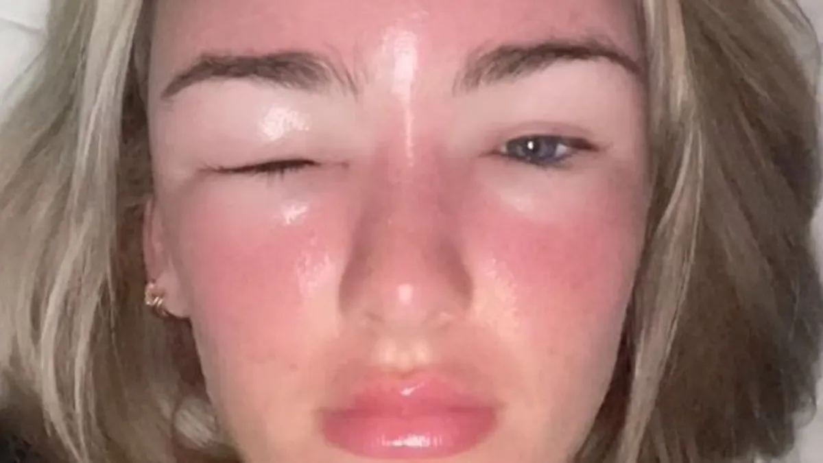 Napmérgezést kapott egy nő, feldagadt az arca - videó