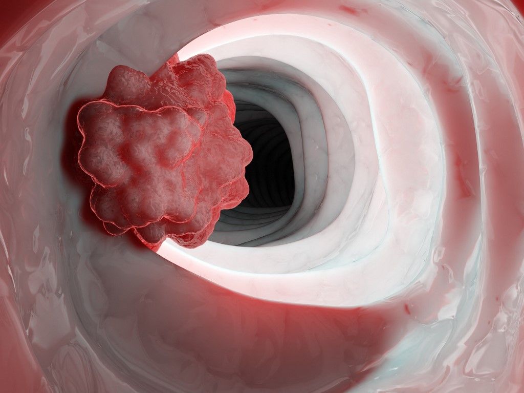 bélrák Colon tumour, illustration