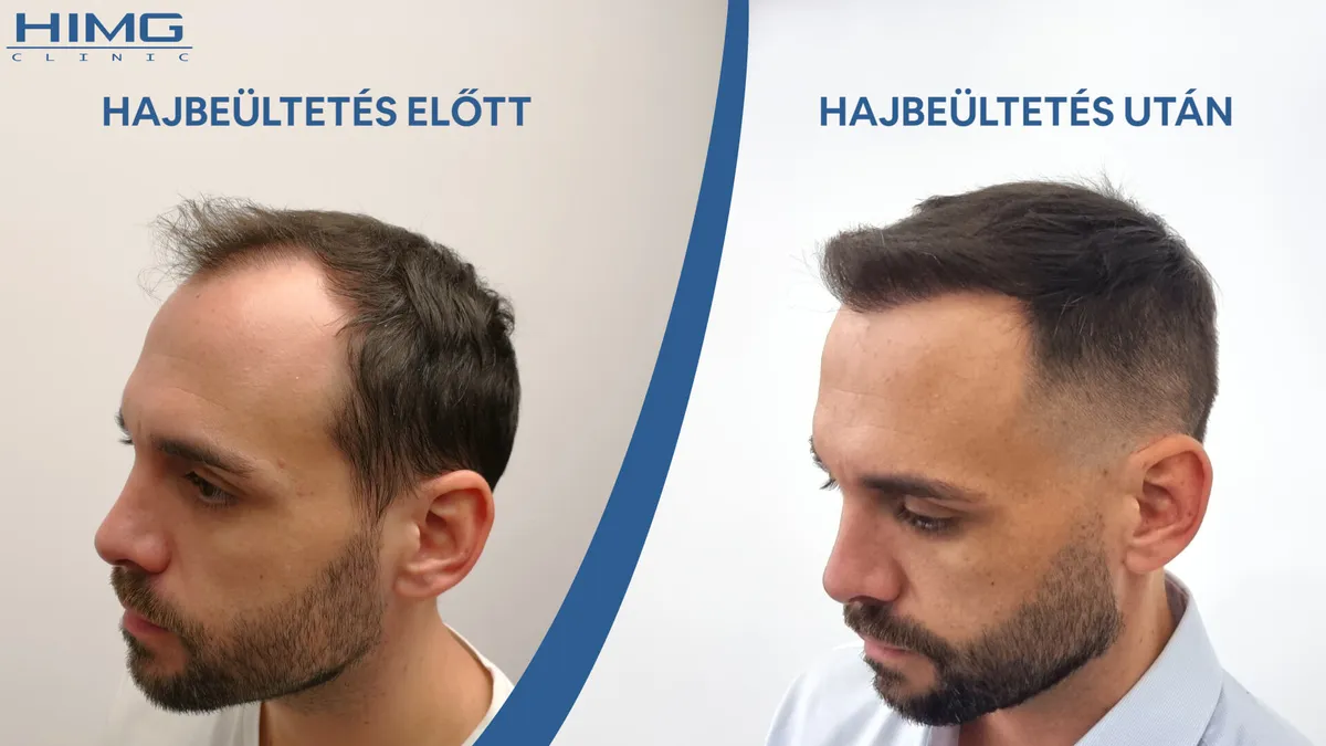 Melyik hajbeültetés a legjobb?