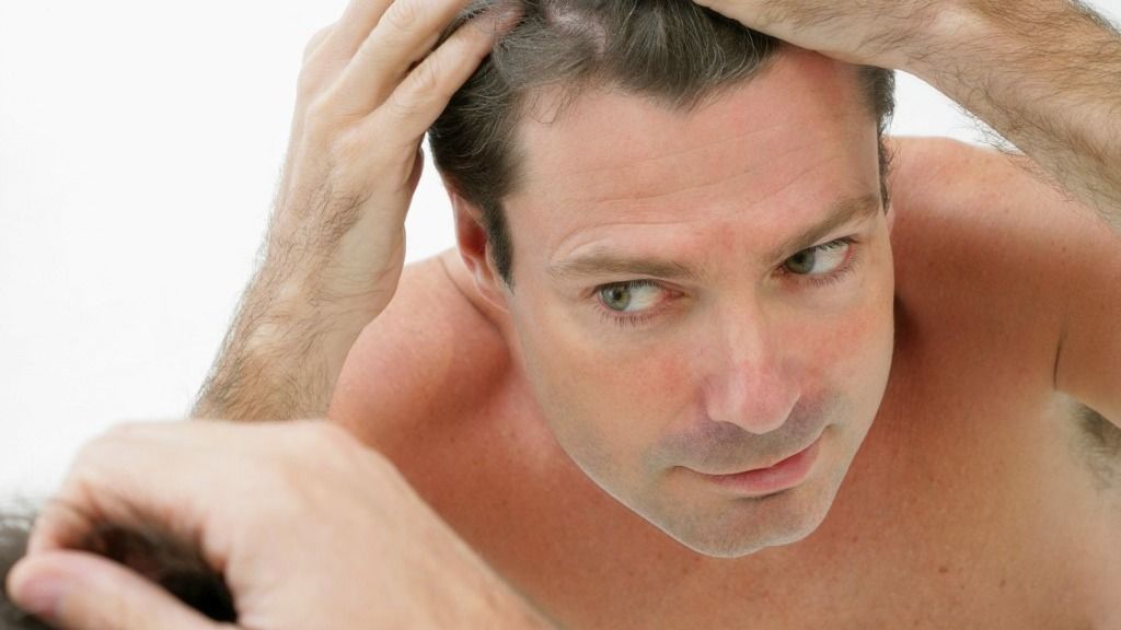 A férfias típusú hajhullás a férfiak 50 százalékát is érintheti