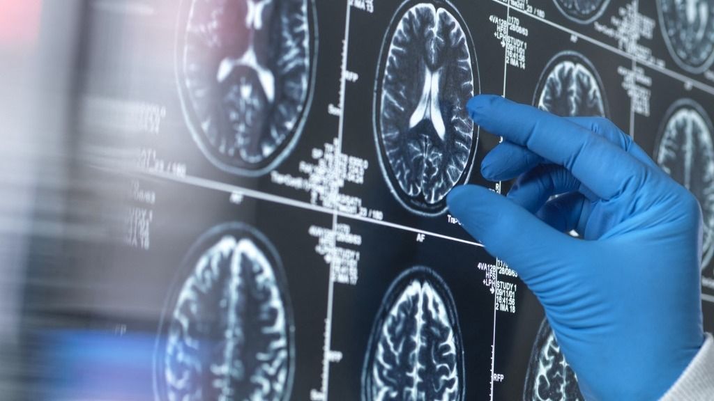 Magyar kutatók tíz évvel ezelőtt kezdték vizsgálni az Alzheimer-kór és az epilepszia kapcsolatát.