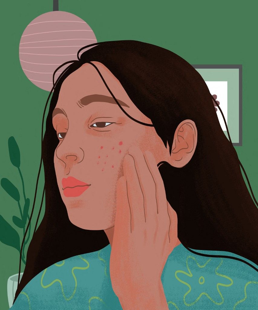 Woman with acne, illustration