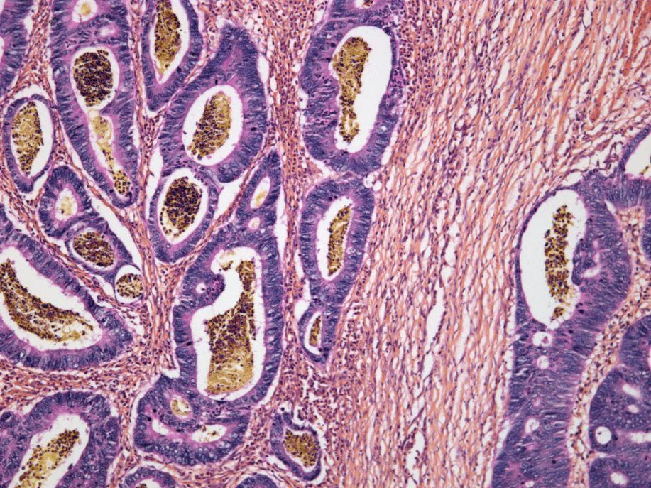 Több tumoros betegnél potenciálisan hatékony az immunterápia