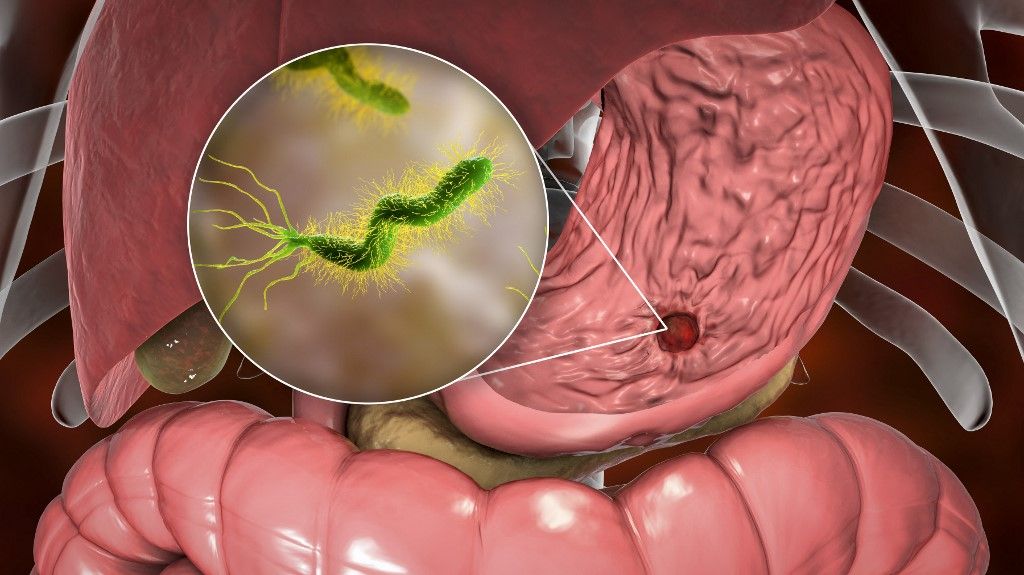 gyomorfekély Helicobacter pylori bacteria, illustration