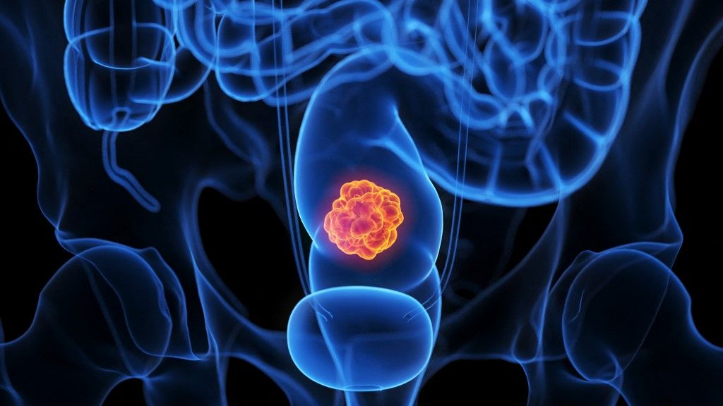 Vastagbélrák szűrése: kiderült, mennyire hatékony a vérteszt - ORIGO