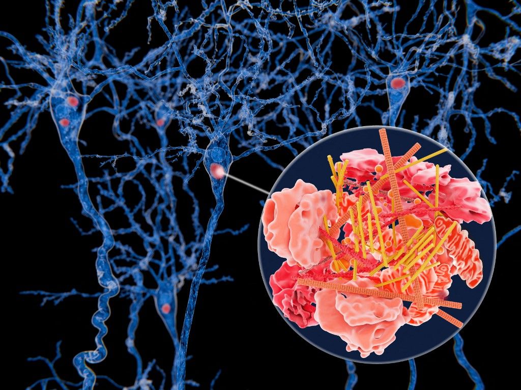 Lewy bodies in nerve cells, illustration